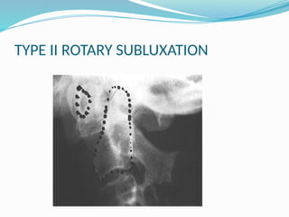 TYPE II ROTARY SUBLUXATION
 