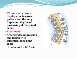  CT more accurately
displays the fracture
pattern and the very
important degree of
narrowing of the spinal
canal.
 Treatment:
 Anterior decompression
and fusion with
tricortical iliac bone
graft
halovest for 8-12 wks
 