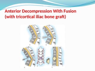 Anterior Decompression With Fusion
(with tricortical iliac bone graft)
 