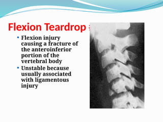 Flexion Teardrop #
 Flexion injury
causing a fracture of
the anteroinferior
portion of the
vertebral body
 Unstable because
usually associated
with ligamentous
injury
 