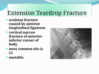 Extension Teardrop Fracture
 avulsion fracture
caused by anterior
longitudinal ligament.
 vertical narrow
fracture of anterior-
inferior corner of
body.
 most common site is
c2.
 unstable.
 