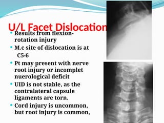 U/L Facet Dislocation
 Results from flexion-
rotation injury
 M.c site of dislocation is at
C5-6
 Pt may present with nerve
root injury or incomplet
nuerological deficit
 UID is not stable, as the
contralateral capsule
ligaments are torn.
 Cord injury is uncommon,
but root injury is common,
 