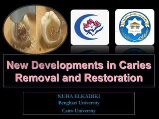 New Developments in Caries
Removal and Restoration
NUHA ELKADIKI
Benghazi University
Cairo University
 