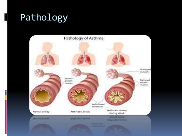 General concepts in asthma treatment | PPT