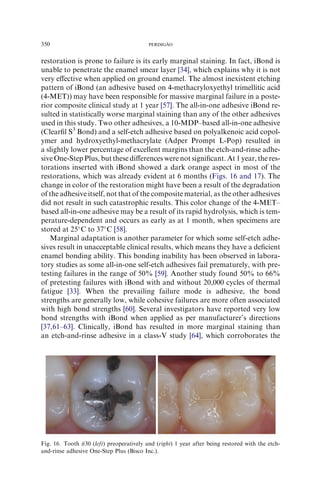 restoration is prone to failure is its early marginal staining. In fact, iBond is
unable to penetrate the enamel smear layer [34], which explains why it is not
very eﬀective when applied on ground enamel. The almost inexistent etching
pattern of iBond (an adhesive based on 4-methacryloxyethyl trimellitic acid
(4-MET)) may have been responsible for massive marginal failure in a poste-
rior composite clinical study at 1 year [57]. The all-in-one adhesive iBond re-
sulted in statistically worse marginal staining than any of the other adhesives
used in this study. Two other adhesives, a 10-MDP–based all-in-one adhesive
(Clearﬁl S3
Bond) and a self-etch adhesive based on polyalkenoic acid copol-
ymer and hydroxyethyl-methacrylate (Adper Prompt L-Pop) resulted in
a slightly lower percentage of excellent margins than the etch-and-rinse adhe-
sive One-Step Plus, but these diﬀerences were not signiﬁcant. At 1 year, the res-
torations inserted with iBond showed a dark orange aspect in most of the
restorations, which was already evident at 6 months (Figs. 16 and 17). The
change in color of the restoration might have been a result of the degradation
of the adhesive itself, not that of the composite material, as the other adhesives
did not result in such catastrophic results. This color change of the 4-MET–
based all-in-one adhesive may be a result of its rapid hydrolysis, which is tem-
perature-dependent and occurs as early as at 1 month, when specimens are
stored at 25
C to 37
C [58].
Marginal adaptation is another parameter for which some self-etch adhe-
sives result in unacceptable clinical results, which means they have a deﬁcient
enamel bonding ability. This bonding inability has been observed in labora-
tory studies as some all-in-one self-etch adhesives fail prematurely, with pre-
testing failures in the range of 50% [59]. Another study found 50% to 66%
of pretesting failures with iBond with and without 20,000 cycles of thermal
fatigue [33]. When the prevailing failure mode is adhesive, the bond
strengths are generally low, while cohesive failures are more often associated
with high bond strengths [60]. Several investigators have reported very low
bond strengths with iBond when applied as per manufacturer’s directions
[37,61–63]. Clinically, iBond has resulted in more marginal staining than
an etch-and-rinse adhesive in a class-V study [64], which corroborates the
Fig. 16. Tooth #30 (left) preoperatively and (right) 1 year after being restored with the etch-
and-rinse adhesive One-Step Plus (Bisco Inc.).
350 PERDIGA˜ O
 