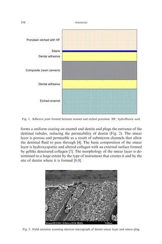 forms a uniform coating on enamel and dentin and plugs the entrance of the
dentinal tubules, reducing the permeability of dentin (Fig. 2). The smear
layer is porous and permeable as a result of submicron channels that allow
the dentinal ﬂuid to pass through [4]. The basic composition of the smear
layer is hydroxyapatite and altered collagen with an external surface formed
by gellike denatured collagen [7]. The morphology of the smear layer is de-
termined to a large extent by the type of instrument that creates it and by the
site of dentin where it is formed [8,9].
Porcelain etched with HF
Composite (resin cement)
Etched enamel
Dental adhesive
Dental adhesive
Silane
Fig. 1. Adhesive joint formed between enamel and etched porcelain. HF, hydroﬂuoric acid.
Fig. 2. Field emission scanning electron micrograph of dentin smear layer and smear plug.
334 PERDIGA˜ O
 