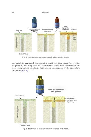 may result in decreased postoperative sensitivity, may make for a better
marginal ﬁt, and may even act as an elastic buﬀer that compensates for
the polymerization shrinkage stress during contraction of the restorative
composite [12–14].
Fig. 4. Interaction of two-bottle self-etch adhesives with dentin.
Fig. 5. Interaction of all-in-one self-etch adhesives with dentin.
336 PERDIGA˜ O
 