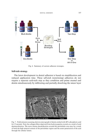 Self-etch strategy
The latest development in dental adhesion is based on simpliﬁcation and
reduced application time. These self-etch (nonrinsing) adhesives do not
require a separate acid-etch step as they condition and prime enamel and
dentin simultaneously by inﬁltrating and partially dissolving the smear layer
Fig. 6. Summary of current adhesion strategies.
Fig. 7. Field emission scanning electron micrograph of dentin etched with 40% phosphoric acid
for 15 seconds. Note the collagen ﬁbers deprived from hydroxyapatite crystals as a result of acid
demineralization. The more intense decalciﬁcation around the peritubular area may be a result
of both the high mineral content of the peritubular region and the easier penetration of the acid
through the tubular lumen.
337DENTAL ADHESION
 