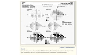 Deperimeterization Example New developments in perimetry | PPTX