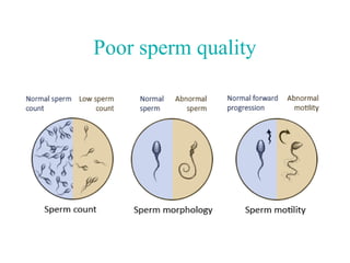 Poor sperm quality
 