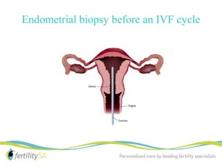 Endometrial biopsy before an IVF cycle
 