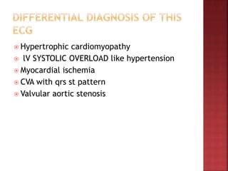  Hypertrophic cardiomyopathy
 lV SYSTOLIC OVERLOAD like hypertension
 Myocardial ischemia
 CVA with qrs st pattern
 Valvular aortic stenosis
 