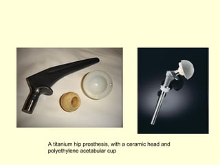 A titanium hip prosthesis, with a ceramic head and 
polyethylene acetabular cup 
 