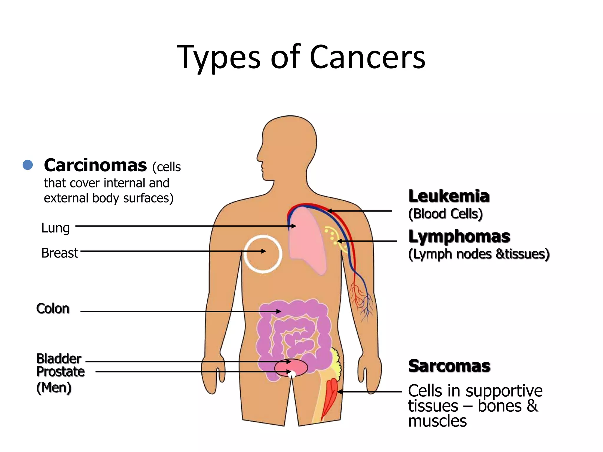  Carcinomas (cells
that cover internal and
external body surfaces)
Types of Cancers
Lung
Breast
Colon
Bladder
Prostate
(Men)
Leukemia
(Blood Cells)
Lymphomas
(Lymph nodes &tissues)
Sarcomas
Cells in supportive
tissues – bones &
muscles
 