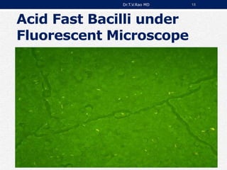 Acid Fast Bacilli under
Fluorescent Microscope
Dr.T.V.Rao MD 18
 