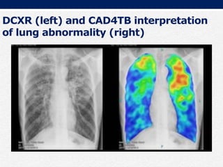 DCXR (left) and CAD4TB interpretation
of lung abnormality (right)
 