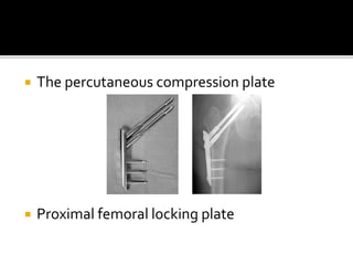  The percutaneous compression plate
 Proximal femoral locking plate
 