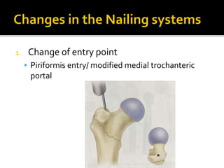1. Change of entry point
 Piriformis entry/ modified medial trochanteric
portal
 
