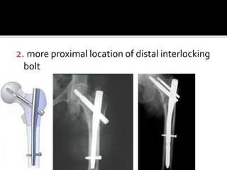 2. more proximal location of distal interlocking
bolt
 