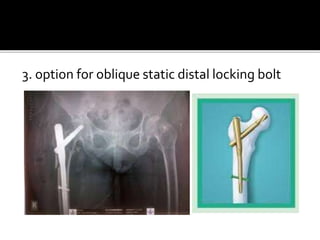 3. option for oblique static distal locking bolt
 