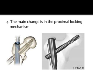 4.The main change is in the proximal locking
mechanism
 
