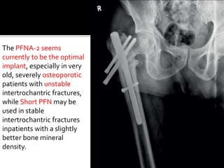 The PFNA-2 seems
currently to be the optimal
implant, especially in very
old, severely osteoporotic
patients with unstable
intertrochantric fractures,
while Short PFN may be
used in stable
intertrochantric fractures
inpatients with a slightly
better bone mineral
density.
 