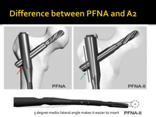 5 degree medio-lateral angle makes it easier to insert
 