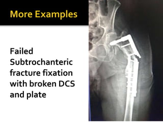 Failed
Subtrochanteric
fracture fixation
with broken DCS
and plate
 