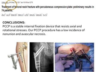 CONCLUSIONS:
PCCP is a stable internal fixation device that resists axial and
rotational stresses. Our PCCP procedure has a low incidence of
nonunion and avascular necrosis.
 