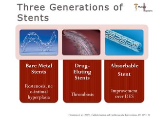 Three Generations of Stents  Ormiston et al. (2007). Catheterization and Cardiovascular Intervention, 69: 129-131 