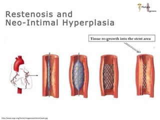 Restenosis  http://www.evgn.org/home/imagesnew/stentv2web.jpg Restenosis and  Neo-Intimal Hyperplasia  Tissue re-growth into the stent area 