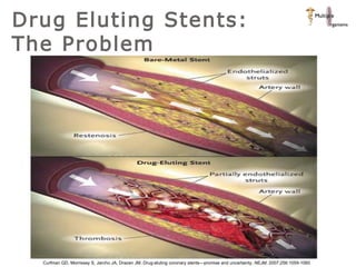 Drug Eluting Stents: The Problem Curfman GD, Morrissey S, Jarcho JA, Drazen JM. Drug-eluting coronary stents—promise and uncertainty.  NEJM . 2007;256:1059-1060 