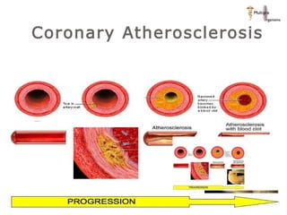 Coronary Atherosclerosis 