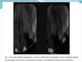 MAXILLARY CANINE impaction techniques.pptx