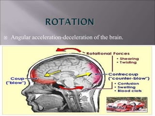  Angular acceleration-deceleration of the brain.
 
