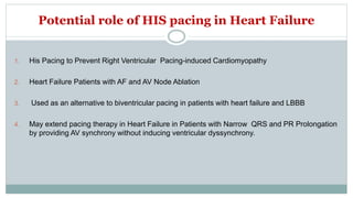 Potential role of HIS pacing in Heart Failure
1. His Pacing to Prevent Right Ventricular Pacing-induced Cardiomyopathy
2. Heart Failure Patients with AF and AV Node Ablation
3. Used as an alternative to biventricular pacing in patients with heart failure and LBBB
4. May extend pacing therapy in Heart Failure in Patients with Narrow QRS and PR Prolongation
by providing AV synchrony without inducing ventricular dyssynchrony.
 