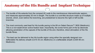 Anatomy of the His Bundle and Implant Technique
 The bundle of His extends from the compact AV node to the membranous interventricular septum,
and measures approximately 20 mm in length. The bundle is a cord-like structure made up of multiple
strands, which, even before the branching, are predestined to become the right or left bundle
branches
 The most commonly used lead for His bundle pacing is the 69 cm Select Secure™ 3830 (Medtronic).
This is a non-stylet-driven active fixation lead. Importantly, the screw forms part of the tip electrode
allowing penetration of the capsule of the bundle of His and, therefore, direct stimulation of the His
bundle fibres.
 The lead can be delivered to the His bundle region using either the specially designed non-
deflectable His delivery sheath (C315 43 cm; Medtronic) or a deflectable sheath (C304 69 cm;
Medtronic).
 