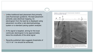  Unlike traditional lead placement that primarily
uses fluoroscopic guidance, His lead placement
primarily uses electrical mapping. An
electrogram from the lead tip is displayed using
placement via either a lab electrophysiology
system or a standard pacing system analyser.
 A His signal is targeted, aiming for the local
ventricular electrogram to be approximately
twice the amplitude of the atrial signal
 Recently-published data suggests thresholds of
<2.5 V at 1 ms should be achieved.
 