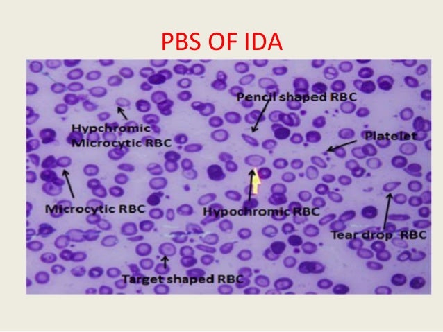 IRON DEFICIENCY ANEMIA
