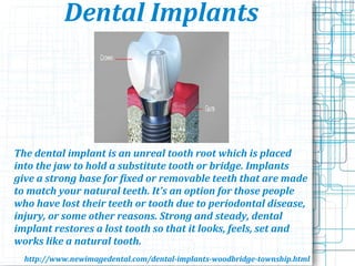 Dental Implants
The dental implant is an unreal tooth root which is placed
into the jaw to hold a substitute tooth or bridge. Implants
give a strong base for fixed or removable teeth that are made
to match your natural teeth. It's an option for those people
who have lost their teeth or tooth due to periodontal disease,
injury, or some other reasons. Strong and steady, dental
implant restores a lost tooth so that it looks, feels, set and
works like a natural tooth.
http://www.newimagedental.com/dental-implants-woodbridge-township.html
 
