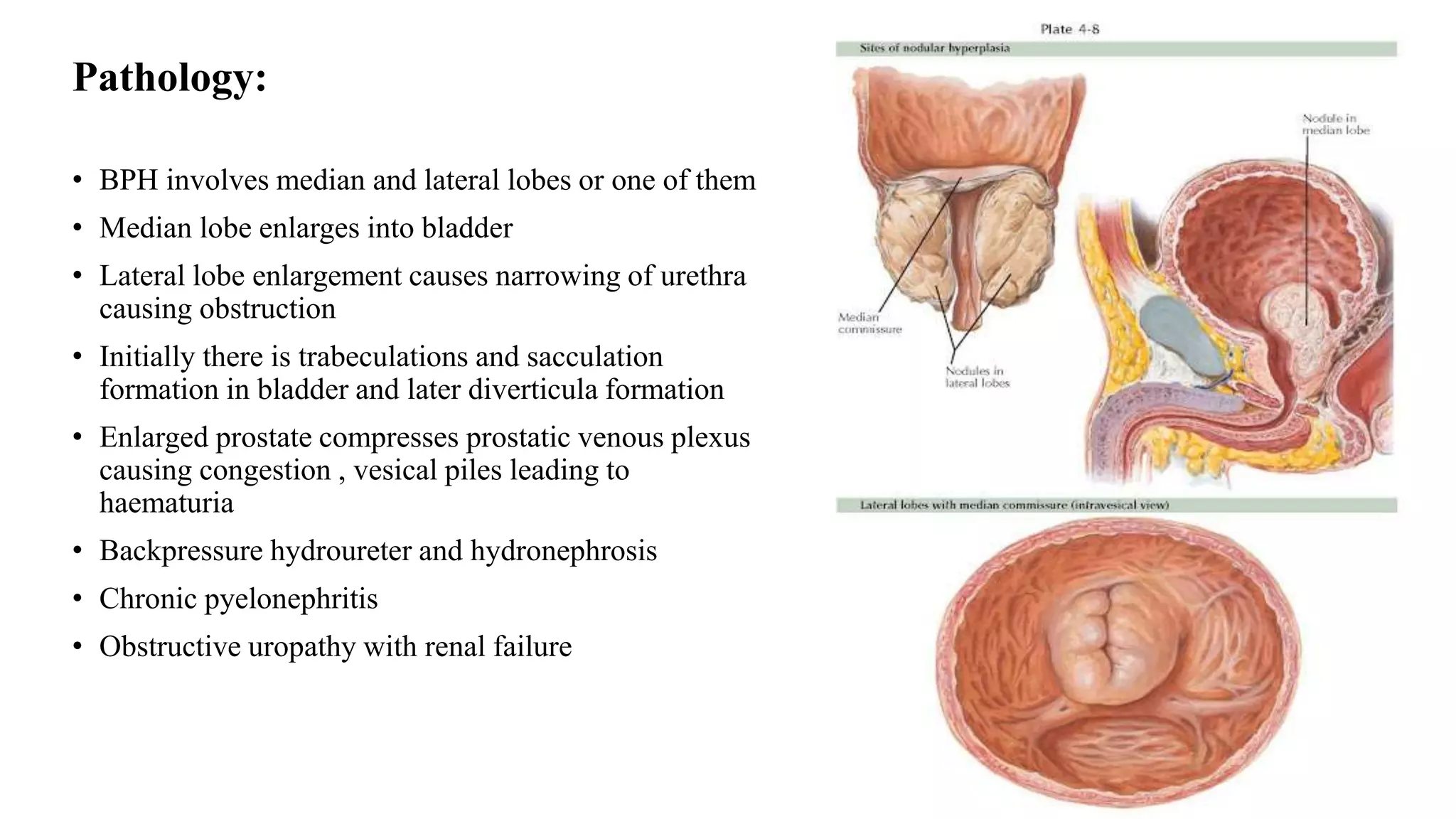 Obstructed Prostate Benign Prostatic Hyperplasia | PPTX