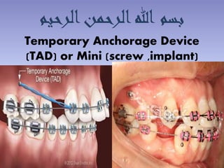 Temporary Anchorage Device
(TAD) or Mini (screw ,implant)
‫الرحيم‬‫الرحمن‬‫هللا‬ ‫بسم‬
 