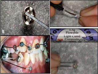 • 4) up righting tilted teeth
 
