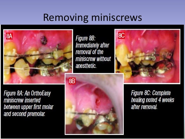 tad orthodontics