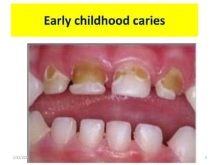 Early childhood caries
2/15/2016 2
 