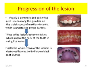 Progression of the lesion
• Initially a demineralized dull,white
area is seen along the gum line on
the labial aspect of maxillary incisors,
which is undetected by the parents.
These white lesions become cavities
which involve the neck of the tooth in
a ring like lesion.
Finally the whole crown of the incisors is
destroyed leaving behind brown black
root stumps
2/15/2016 24
 