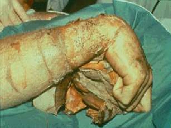 burn seminar