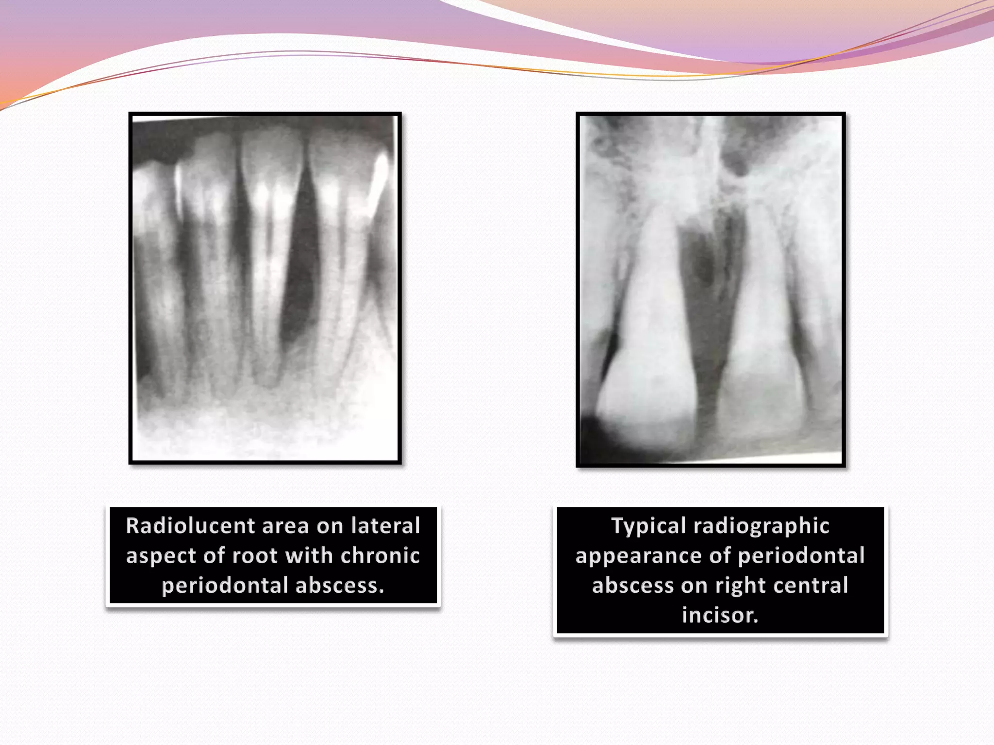 RADIOGRAPHIC AIDS IN THE DIAGNOSIS OF PERIODONTAL DISEASE | PPTX