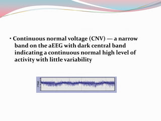 • Continuous normal voltage (CNV) — a narrow
band on the aEEG with dark central band
indicating a continuous normal high level of
activity with little variability

 