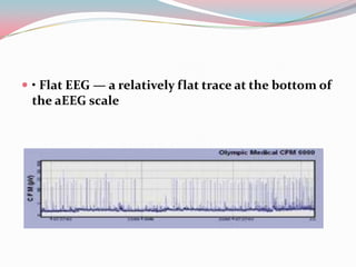  • Flat EEG — a relatively flat trace at the bottom of

the aEEG scale

 